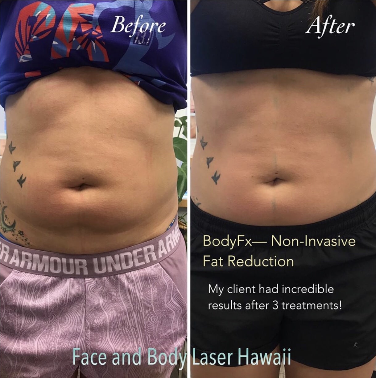 Laser Fat Reduction, laser liposuction hawaii