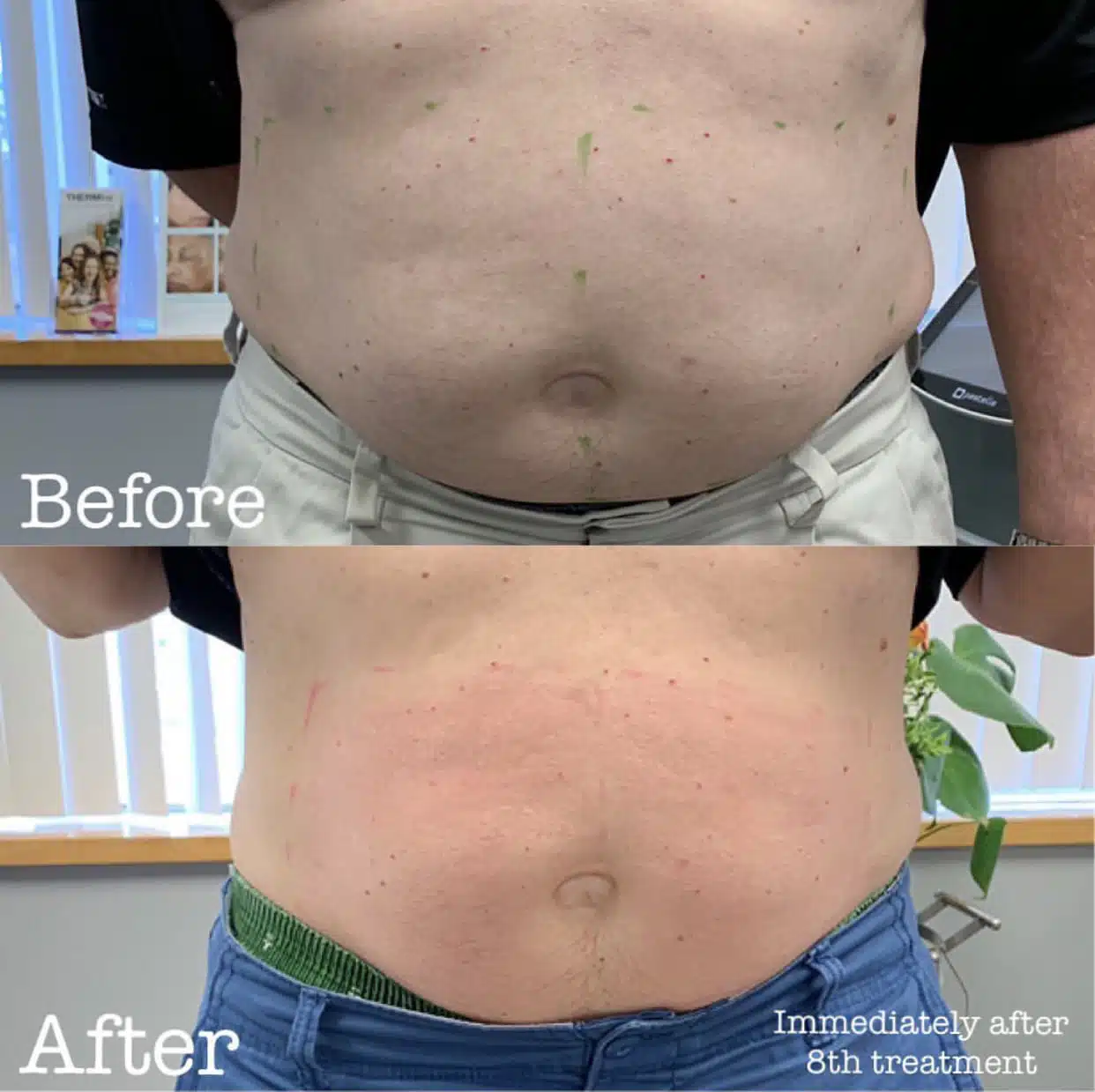 Non Invasive Fat Reduction Honolulu Face and Body Laser