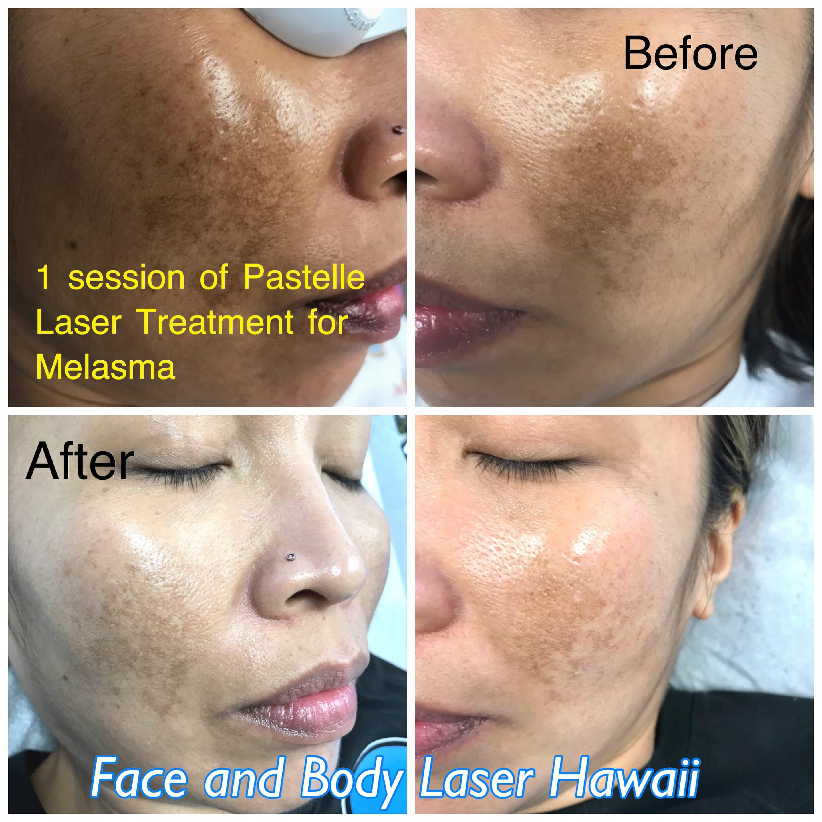Skin Resurfacing Image